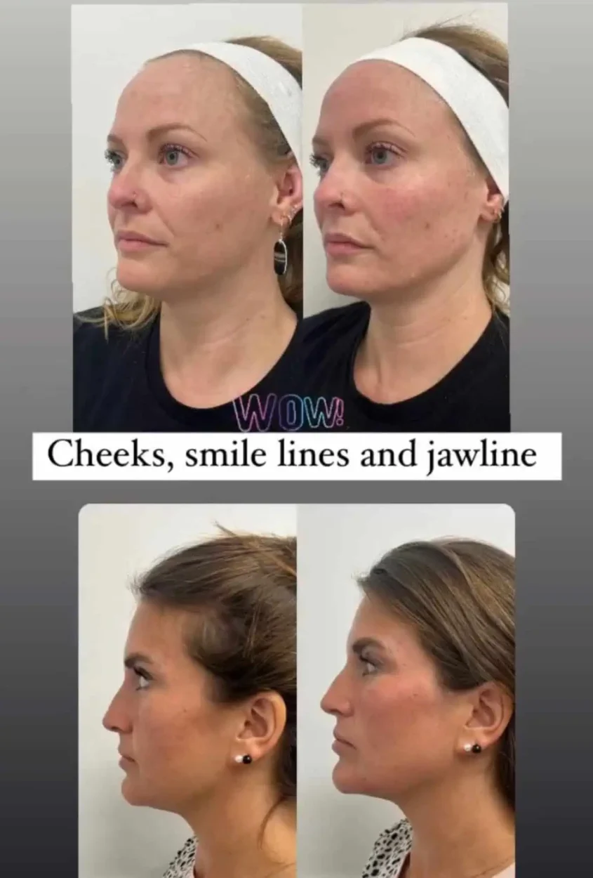 Facial-balancing-2