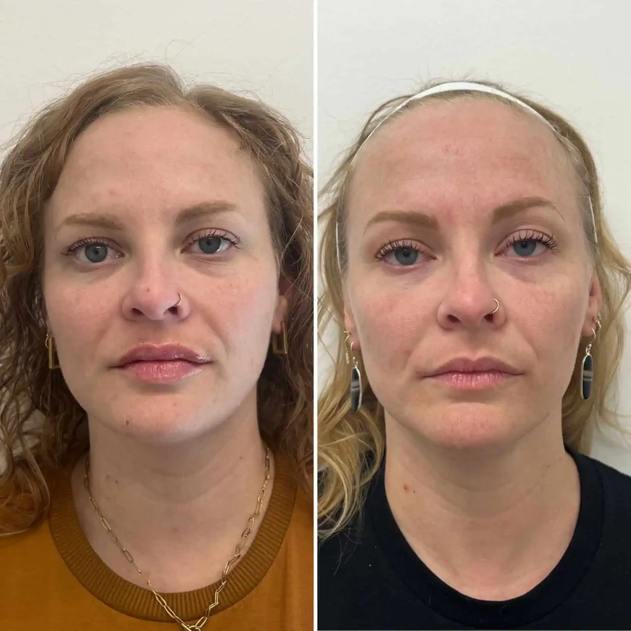 Facial-balancing-before-after-2