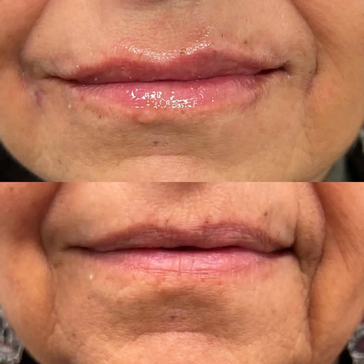 Lip-before-after-2