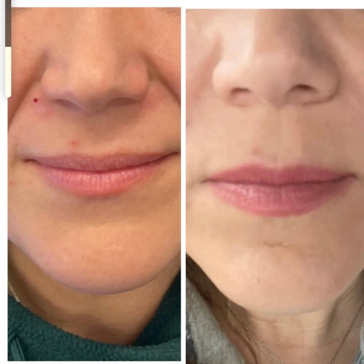 Lips-before-after-3