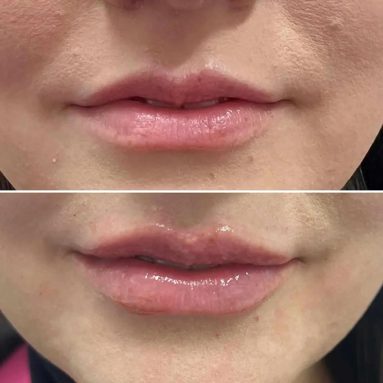 Lips-before-and-after-2